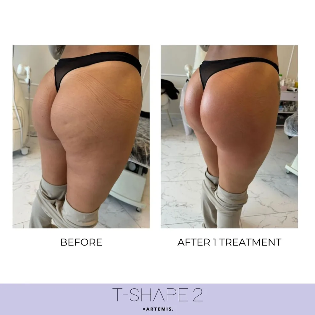 Buttocks seen from the side, before and after 1 treatment.