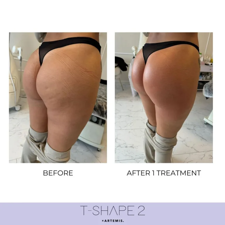 Tshape 2
