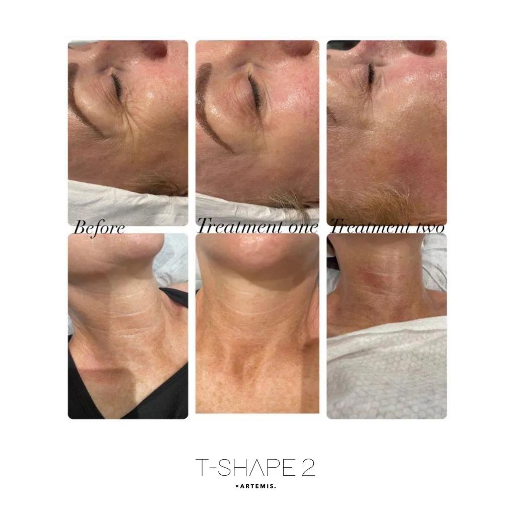 Cheek and neck skin before treatment, after treatment one and after treatment two
