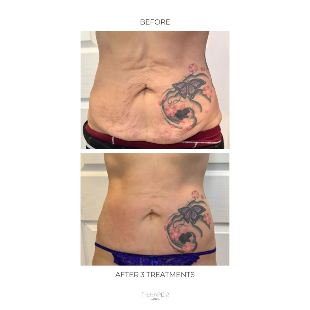 Tattooed abdomen, before and after 3 treatments.