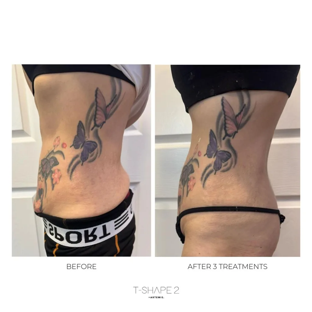 Tattooed side and lower back, before and after 3 treatments.