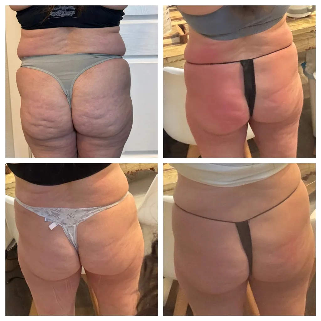 Four rear-view photos of buttocks and thighs, before and after.