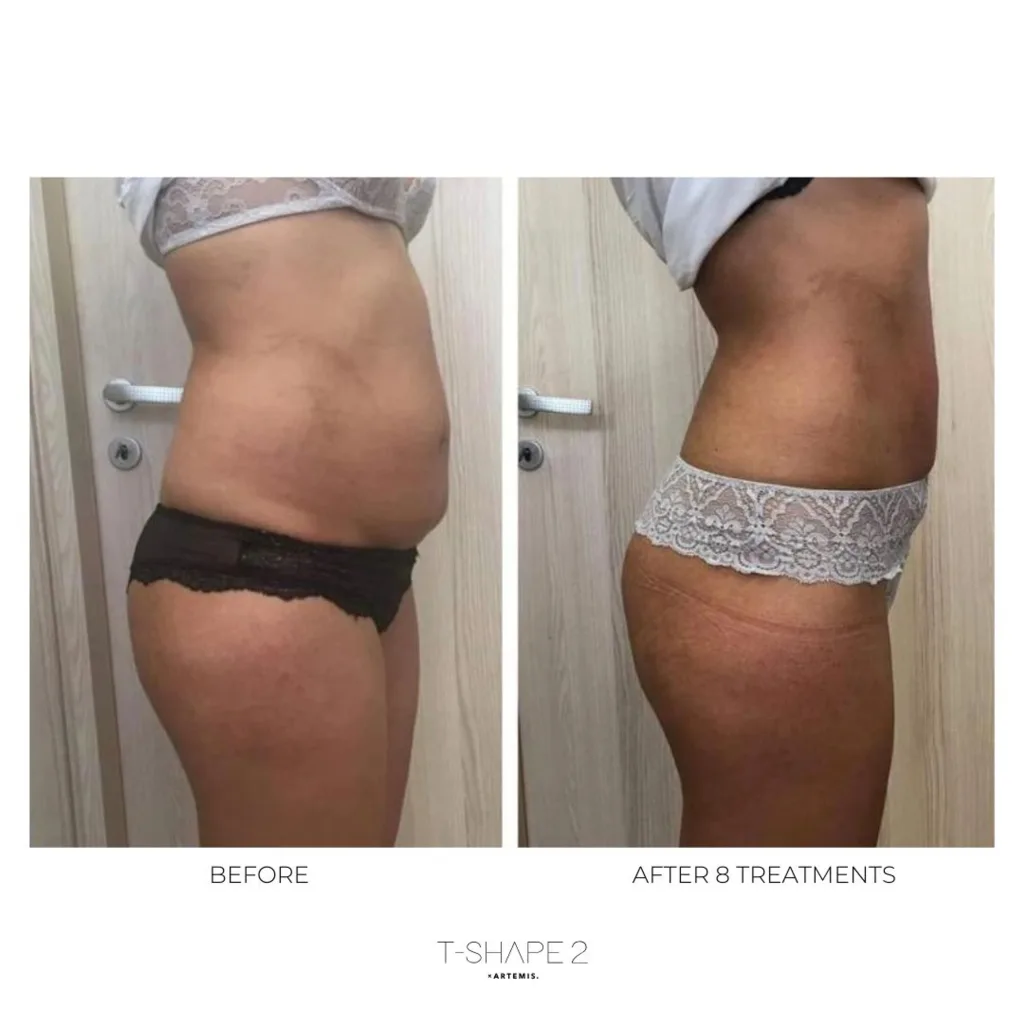 Side view of a woman's abdomen, before and after 8 treatments.