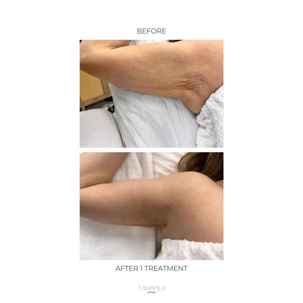 Underside of an upper arm, before and after 1 treatment.