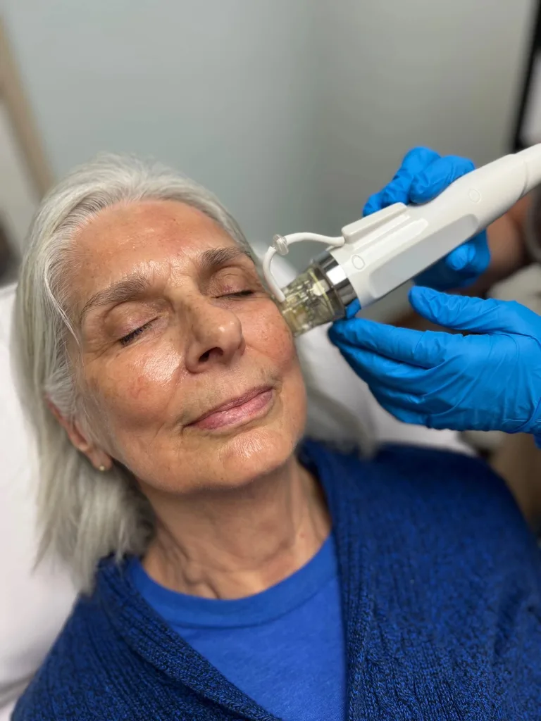 A client rests with her eyes closed during an RF microneedling treatment on her cheek