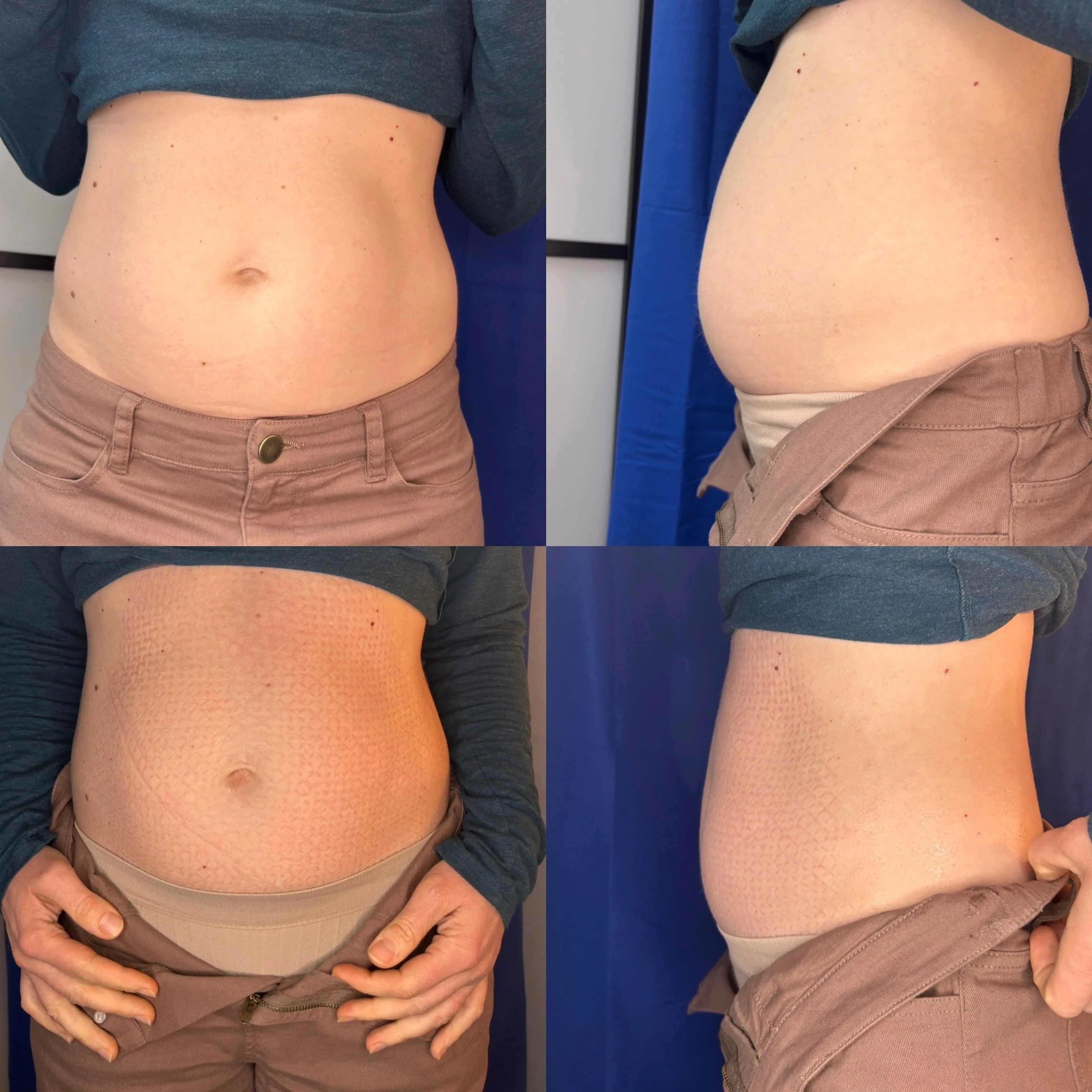 Before and after Tshape 2 body contouring: a client's abdomen shown from the front and side