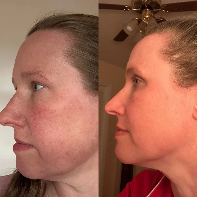 How to Maintain Botox Results Longer: 2026 Guide