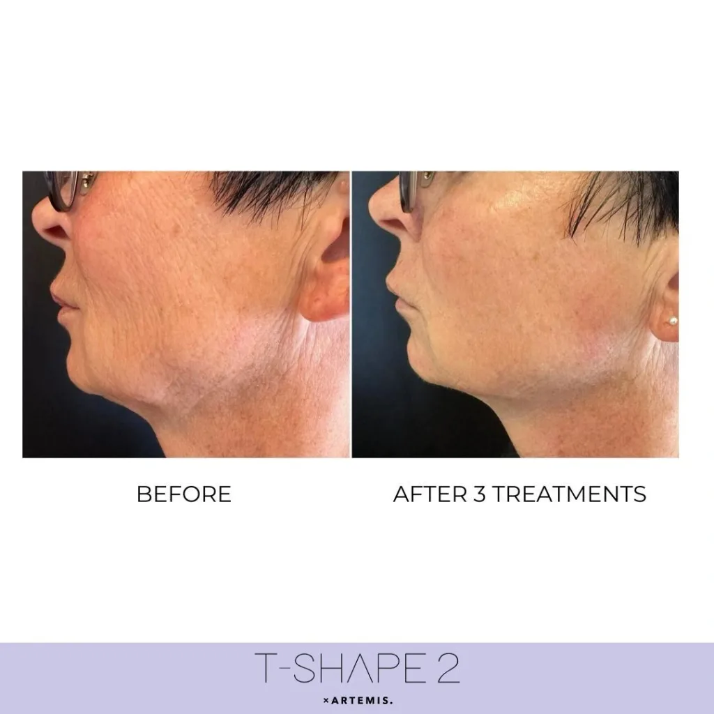 Side view of a jaw and neck before and after 3 T-Shape 2 treatments